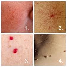 4 verschillende plaatjes met huidoneffenheden.nummer 1: couperose, 2: spider neavi, 3. Bloedblaasjes, 4. Fibromen (steelwratjes)